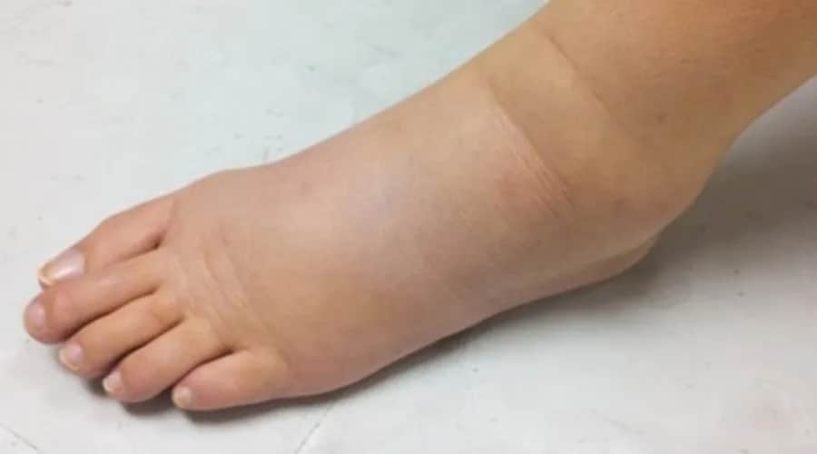 Ile trzyma opuchlizna po skręceniu? Czas gojenia i porady