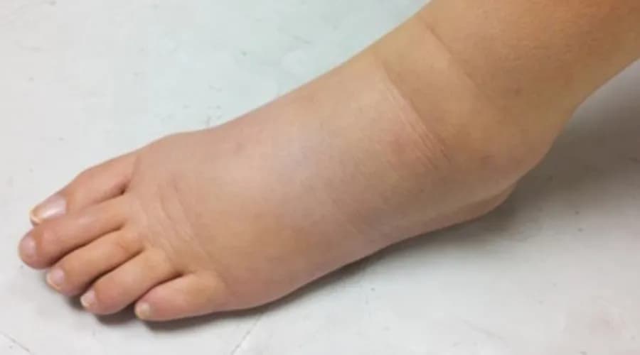 Ile trzyma opuchlizna po skręceniu? Czas gojenia i porady