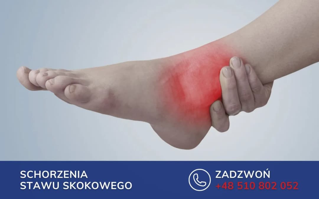 Skręcenie kostki objawy: Jak rozpoznać ból i obrzęk stawu skokowego
