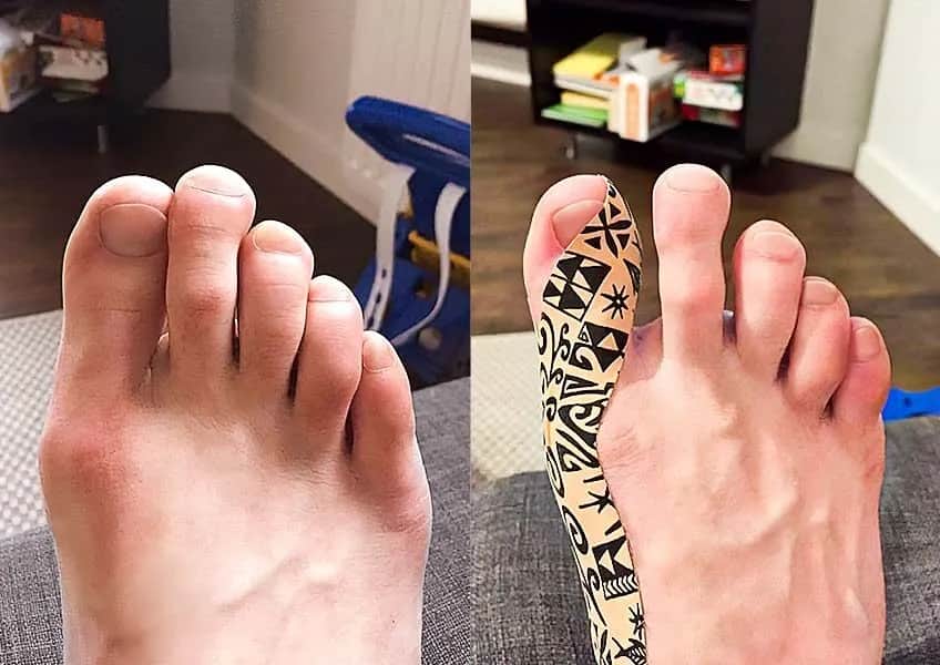 Jak zrobić opatrunek po operacji haluksa, aby uniknąć komplikacji