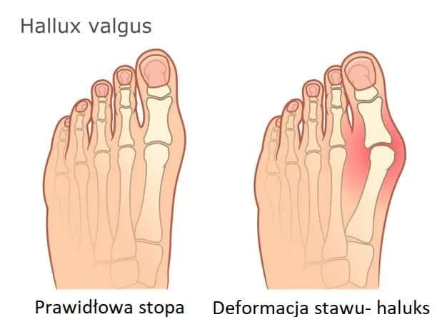 Skuteczne sposoby na ból haluksa, które przynoszą ulgę i komfort