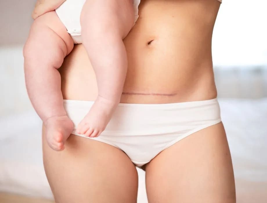 Kiedy do fizjoterapeuty po cc? Kluczowe wskazówki dla mam po cesarce