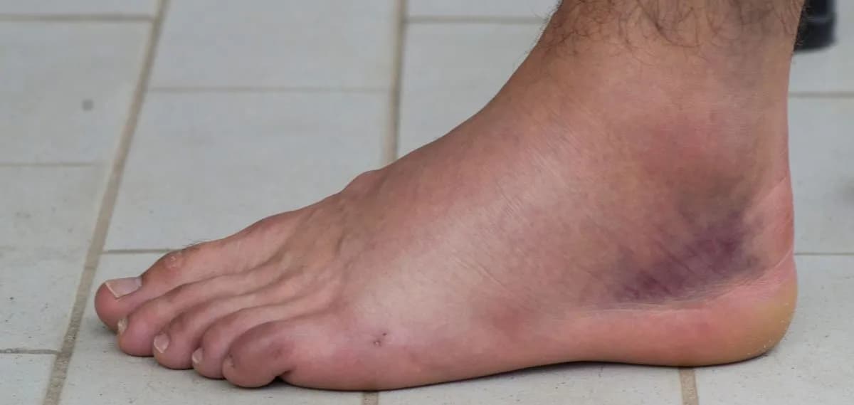 Co na skręcenie kostki: skuteczne metody łagodzenia bólu i leczenia