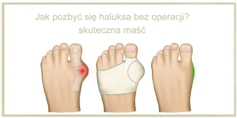 Jak skutecznie pozbyć się haluksów - sprawdzone metody i porady