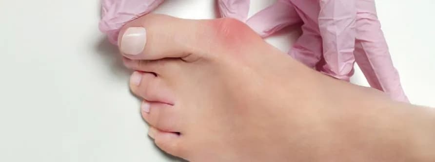 Jak powstają haluksy? Odkryj przyczyny i czynniki ryzyka tej deformacji