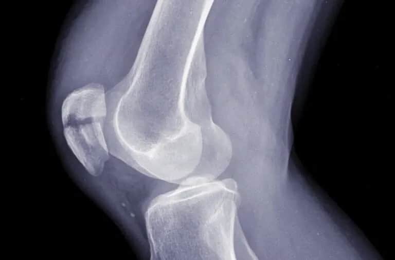 Jak wygląda skręcone kolano? Objawy, które musisz znać