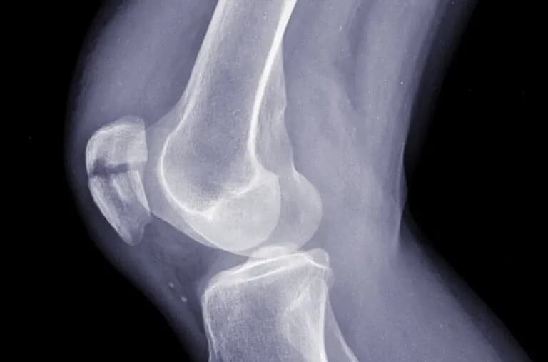 Jak wygląda skręcone kolano? Objawy, które musisz znać