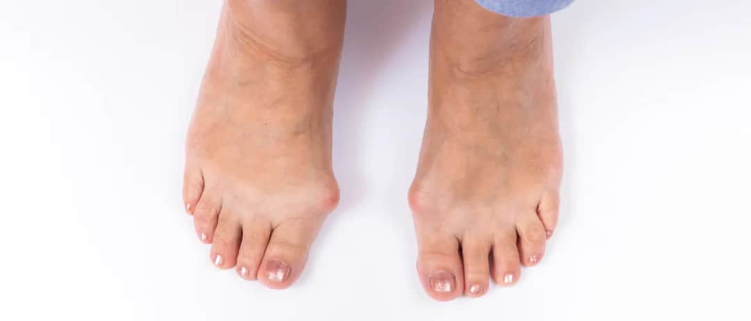 Haluksy objawy: Jak rozpoznać i uniknąć bólu stóp