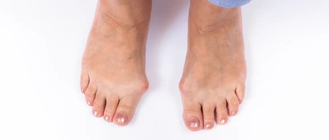 Haluksy objawy: Jak rozpoznać i uniknąć bólu stóp