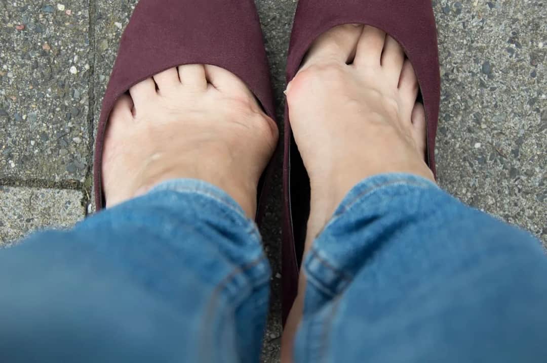 Jak zapobiegać haluksom i uniknąć bólu stóp na co dzień