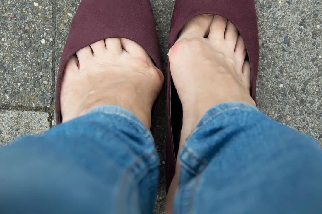 Jak zapobiegać haluksom i uniknąć bólu stóp na co dzień