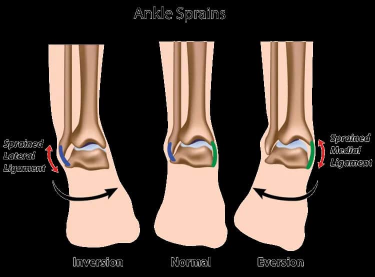 Skręcona kostka ile się goi? Poznaj czas regeneracji i rehabilitacji
