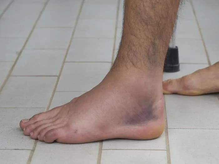 Skręcona kostka co robić? Skuteczne metody na szybkie wyleczenie