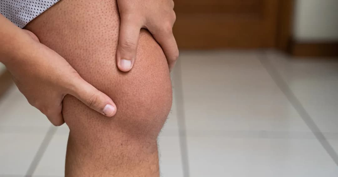 Skręcenie kolana objawy - jak rozpoznać i co zrobić w razie urazu