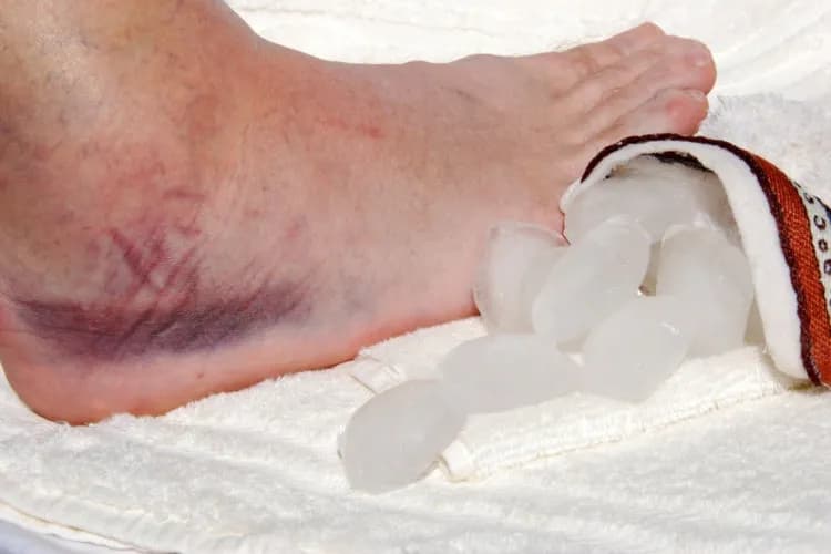 Jak sprawdzić czy kostka jest skręcona - objawy i pierwsza pomoc