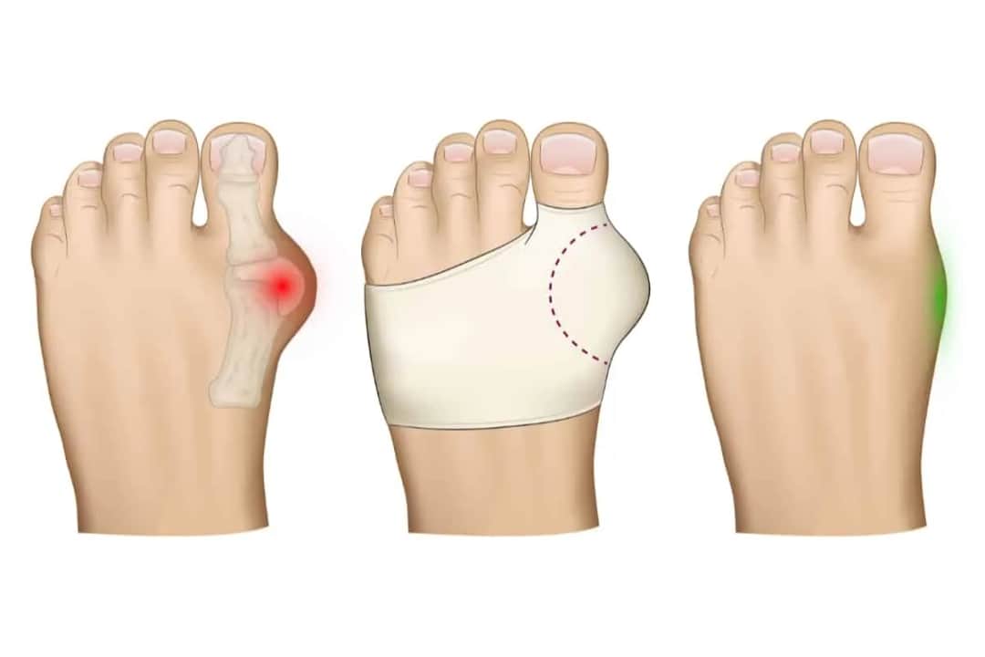 Czym smarować haluksy, aby skutecznie złagodzić ból i dyskomfort