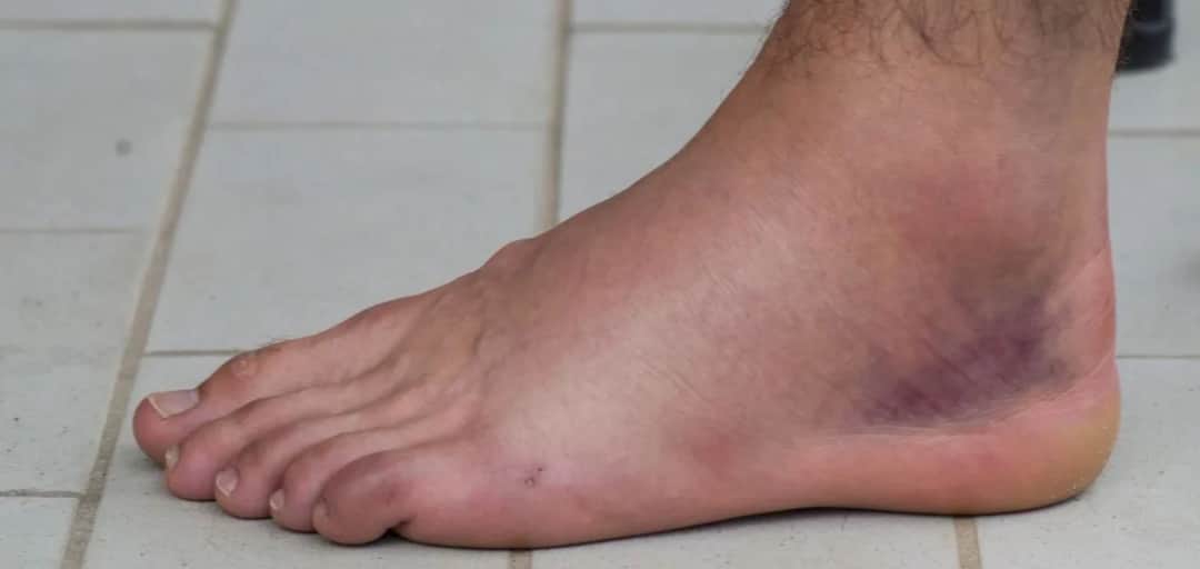 Skręcenie stawu skokowego: ile zwolnienia lekarskiego potrzebujesz?