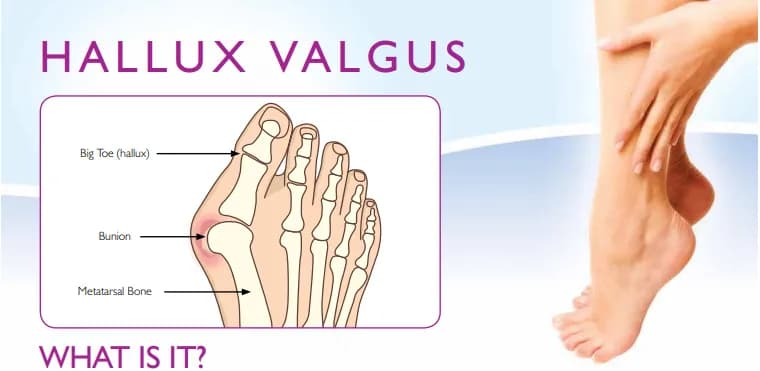 Jakie zabiegi na haluksy są najskuteczniejsze i jak uniknąć bólu?